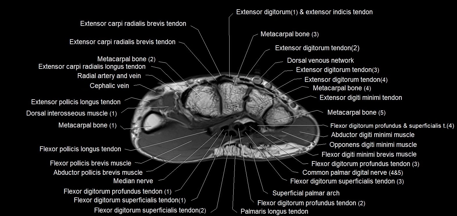 MRI 3T  hand axial labelled cross sectional anatomy imagemy  7.webp